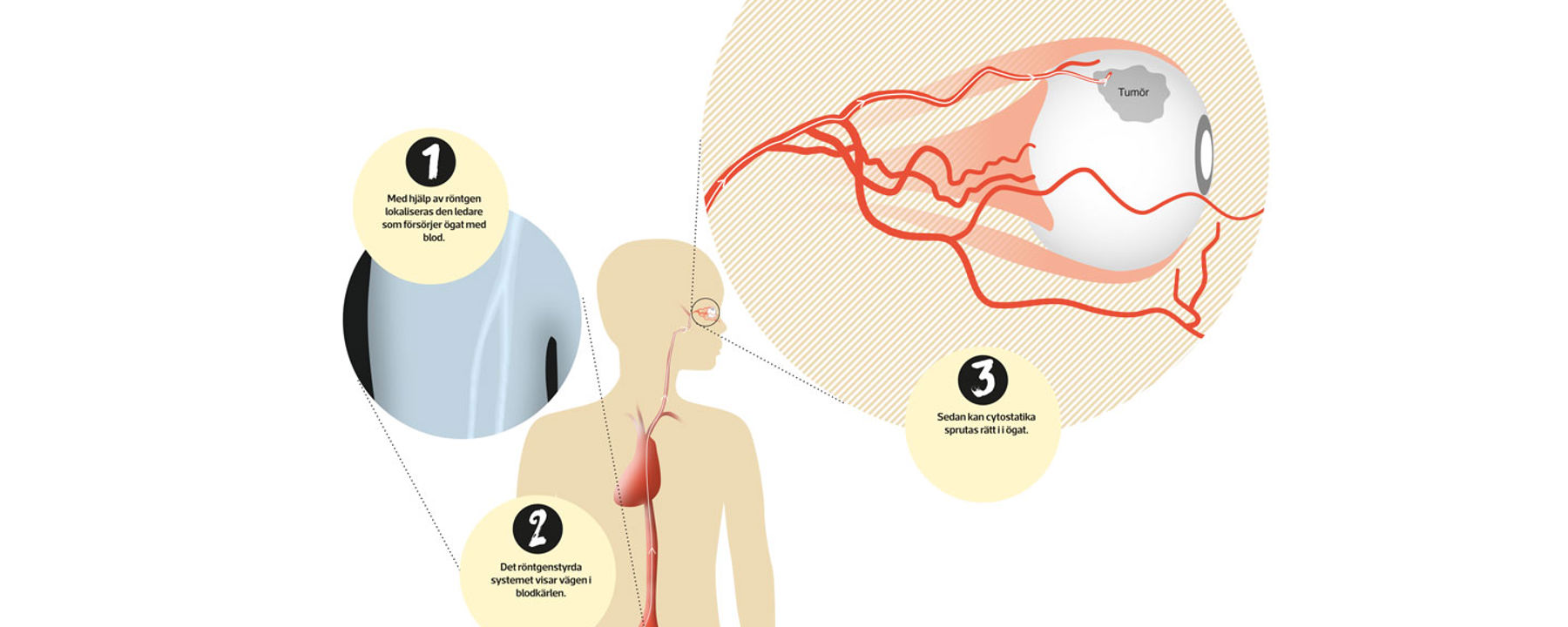 Illustration av ett öga och hur cytostatika färdas via blodkärl från ljumsken.